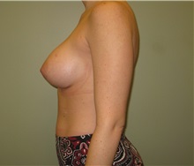 Breast Augmentation After Photo by Badar Jan, MD; Allentown, PA - Case 30996