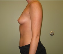 Breast Augmentation Before Photo by Badar Jan, MD; Allentown, PA - Case 30996