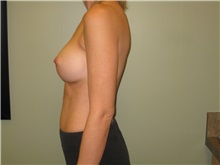 Breast Augmentation After Photo by Badar Jan, MD; Allentown, PA - Case 30997