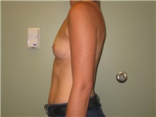 Breast Augmentation Before Photo by Badar Jan, MD; Allentown, PA - Case 30997