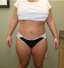Tummy Tuck After Photo by Badar Jan, MD; Allentown, PA - Case 35086