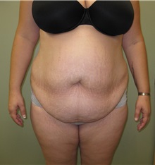 Tummy Tuck Before Photo by Badar Jan, MD; Allentown, PA - Case 35086