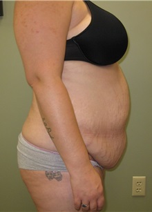Tummy Tuck Before Photo by Badar Jan, MD; Allentown, PA - Case 35086