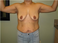 Arm Lift Before Photo by Badar Jan, MD; Allentown, PA - Case 37186