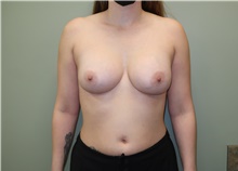 Breast Augmentation After Photo by Badar Jan, MD; Allentown, PA - Case 42782