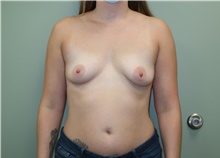 Breast Augmentation Before Photo by Badar Jan, MD; Allentown, PA - Case 42782