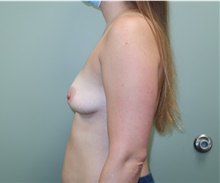 Breast Augmentation Before Photo by Badar Jan, MD; Allentown, PA - Case 42782