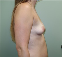 Breast Augmentation Before Photo by Badar Jan, MD; Allentown, PA - Case 42782