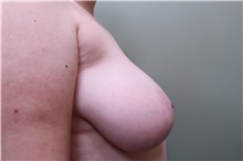 Breast Reduction Before Photo by Badar Jan, MD; Allentown, PA - Case 44493