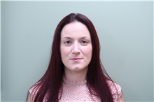 Rhinoplasty After Photo by Badar Jan, MD; Allentown, PA - Case 44677