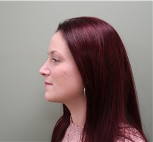 Rhinoplasty After Photo by Badar Jan, MD; Allentown, PA - Case 44677