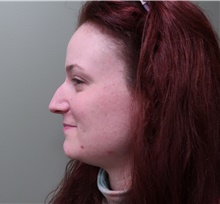 Rhinoplasty Before Photo by Badar Jan, MD; Allentown, PA - Case 44677