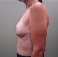 Breast Lift After Photo by Badar Jan, MD; Allentown, PA - Case 44696
