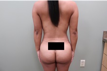 Buttock Lift with Augmentation After Photo by Badar Jan, MD; Allentown, PA - Case 44718