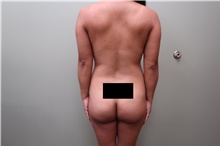 Buttock Lift with Augmentation Before Photo by Badar Jan, MD; Allentown, PA - Case 44718