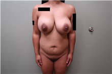 Buttock Lift with Augmentation Before Photo by Badar Jan, MD; Allentown, PA - Case 44718