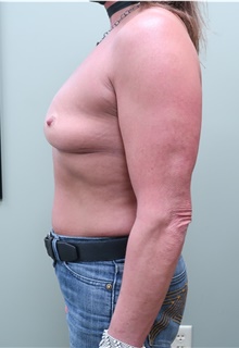 Breast Augmentation Before Photo by Badar Jan, MD; Allentown, PA - Case 44776