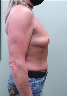 Breast Augmentation Before Photo by Badar Jan, MD; Allentown, PA - Case 44776