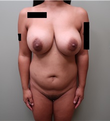 Liposuction Before Photo by Badar Jan, MD; Allentown, PA - Case 44777