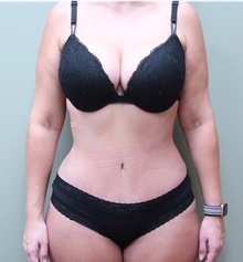 Tummy Tuck After Photo by Badar Jan, MD; Allentown, PA - Case 45443