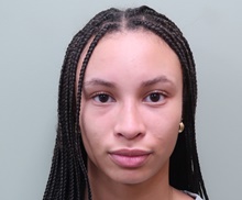 Rhinoplasty After Photo by Badar Jan, MD; Allentown, PA - Case 45506