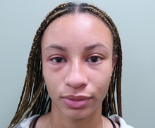 Rhinoplasty Before Photo by Badar Jan, MD; Allentown, PA - Case 45506