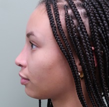 Rhinoplasty After Photo by Badar Jan, MD; Allentown, PA - Case 45506