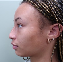 Rhinoplasty Before Photo by Badar Jan, MD; Allentown, PA - Case 45506