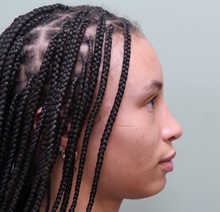 Rhinoplasty After Photo by Badar Jan, MD; Allentown, PA - Case 45506