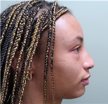 Rhinoplasty Before Photo by Badar Jan, MD; Allentown, PA - Case 45506