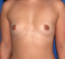 Breast Augmentation Before Photo by James Economides, MD; Arlington, VA - Case 46977
