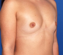 Breast Augmentation Before Photo by James Economides, MD; Arlington, VA - Case 46977