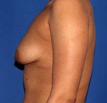 Breast Augmentation Before Photo by James Economides, MD; Arlington, VA - Case 46982