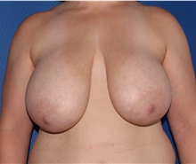 Breast Reduction Before Photo by James Economides, MD; Arlington, VA - Case 46983