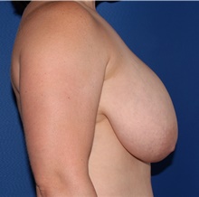 Breast Reduction Before Photo by James Economides, MD; Arlington, VA - Case 46983