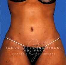 Tummy Tuck After Photo by James Economides, MD; Arlington, VA - Case 47000