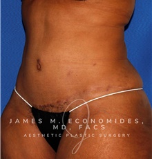 Tummy Tuck After Photo by James Economides, MD; Arlington, VA - Case 47000