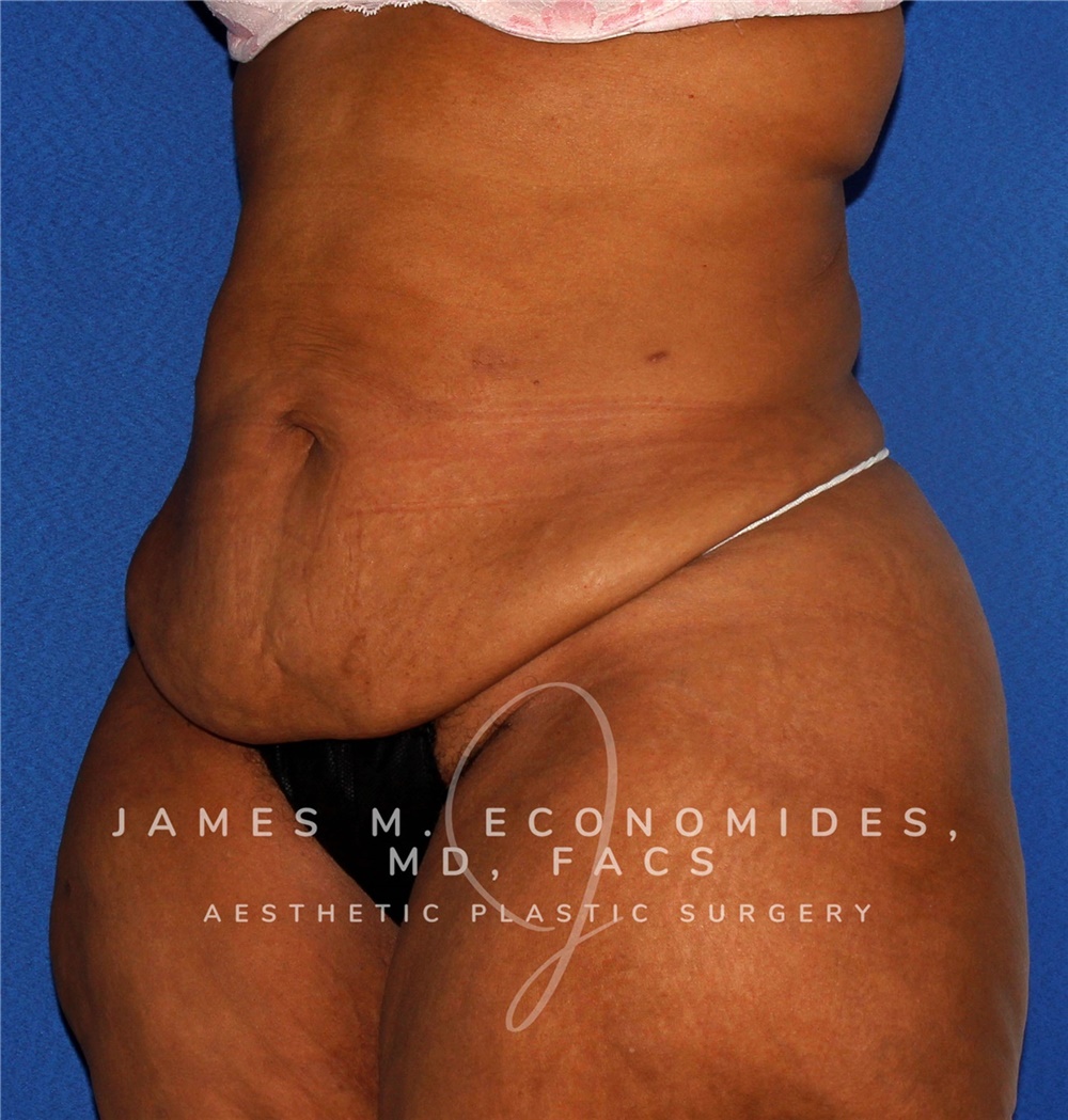 Tummy Tuck Before and After Photos by James Economides, MD; Arlington, VA