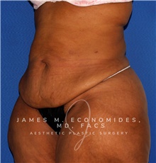 Tummy Tuck Before Photo by James Economides, MD; Arlington, VA - Case 47000
