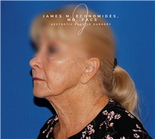Facelift Before Photo by James Economides, MD; Arlington, VA - Case 47060