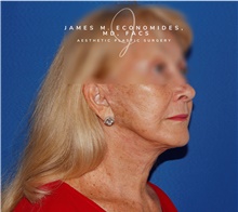 Facelift After Photo by James Economides, MD; Arlington, VA - Case 47060