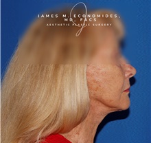 Facelift After Photo by James Economides, MD; Arlington, VA - Case 47060