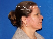 Facelift After Photo by James Economides, MD; Arlington, VA - Case 47089