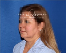 Facelift Before Photo by James Economides, MD; Arlington, VA - Case 47089