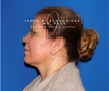 Facelift After Photo by James Economides, MD; Arlington, VA - Case 47089