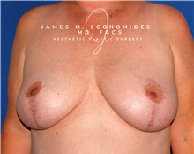 Breast Lift After Photo by James Economides, MD; Arlington, VA - Case 47133