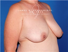 Breast Lift Before Photo by James Economides, MD; Arlington, VA - Case 47133