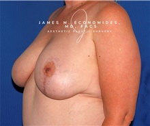 Breast Lift After Photo by James Economides, MD; Arlington, VA - Case 47133