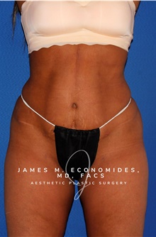 Liposuction After Photo by James Economides, MD; Arlington, VA - Case 47142