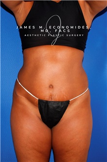 Liposuction Before Photo by James Economides, MD; Arlington, VA - Case 47142